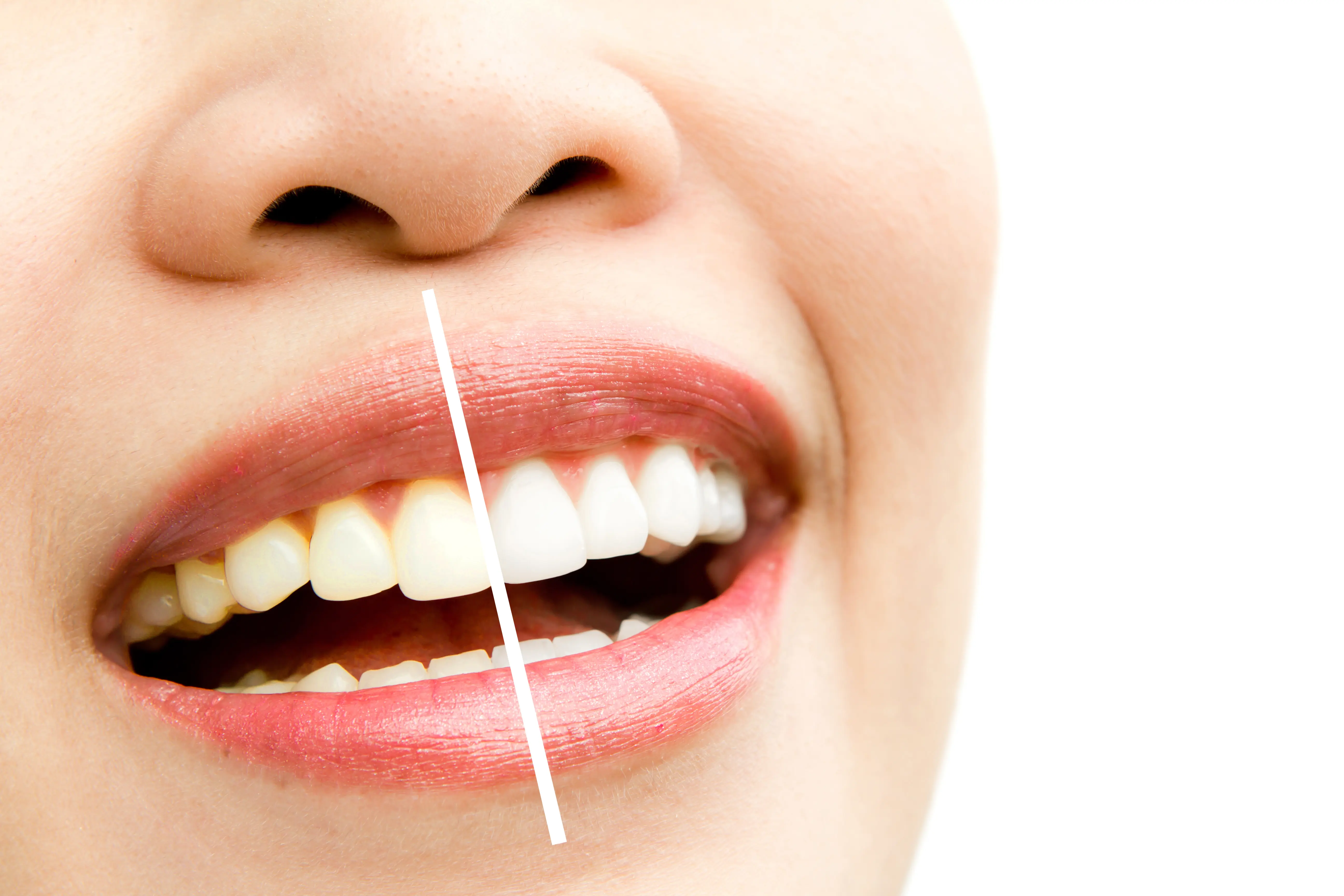 Teeth Whitening Treatment at Dr. Akshay's DentAvenue